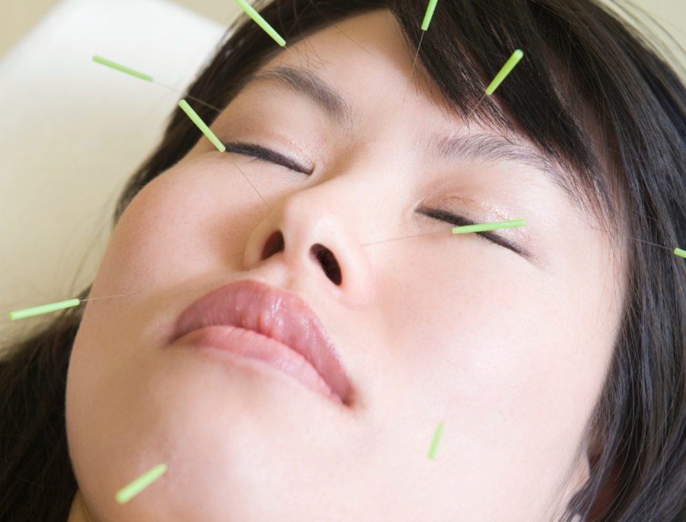 Lidylle cosmetic facial acupuncture course